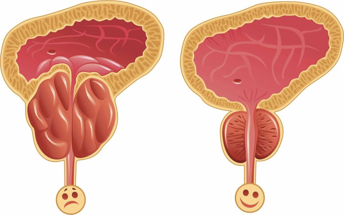 Prostata prije i poslije liječenja kapsulama Prostaffect