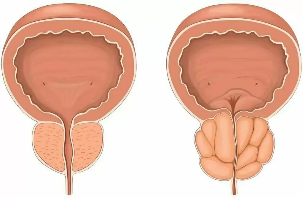 normalna prostata i bolesna prostata