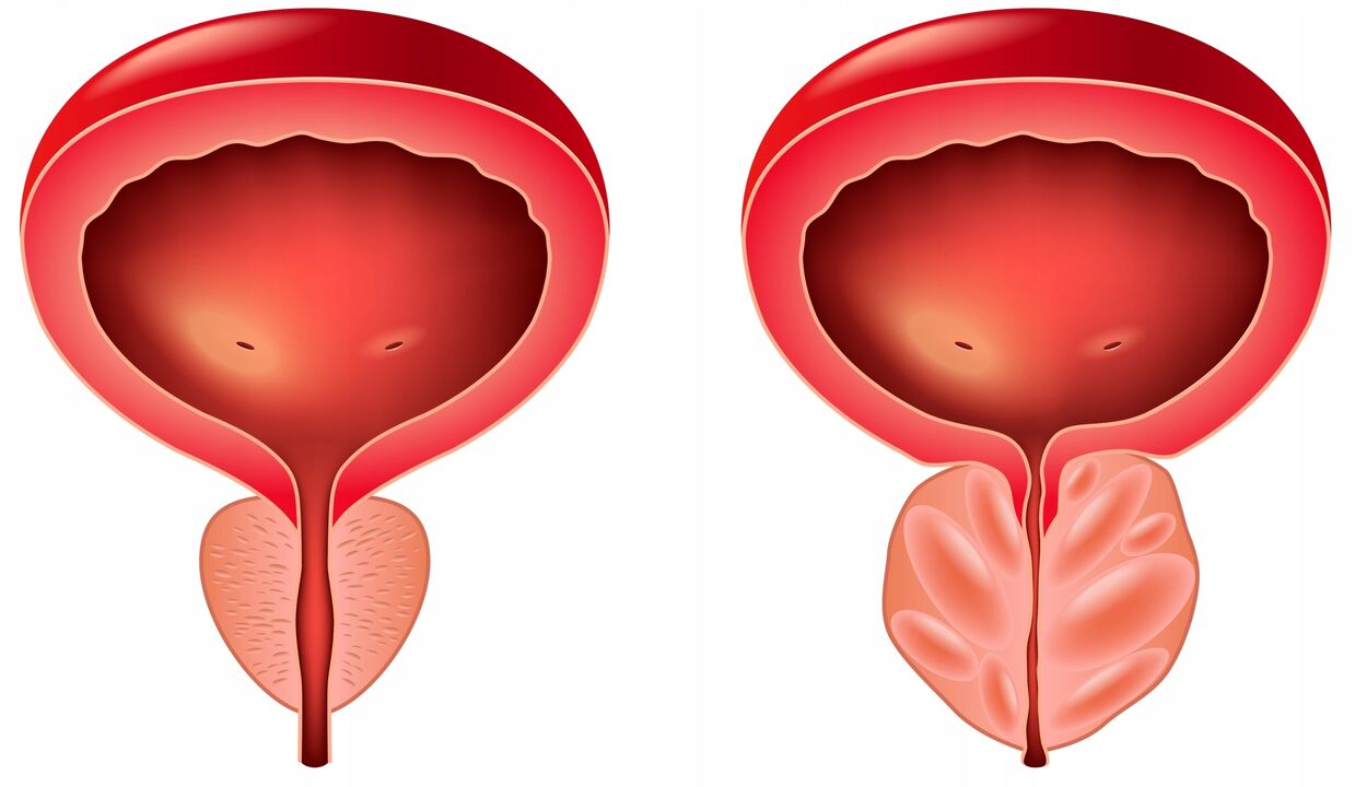 razlika između žlijezda prostate